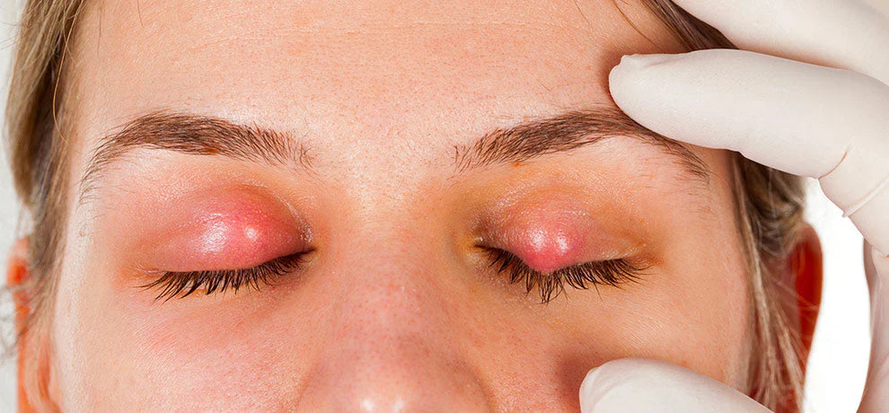 Orgelet : comment le soigner naturellement ?