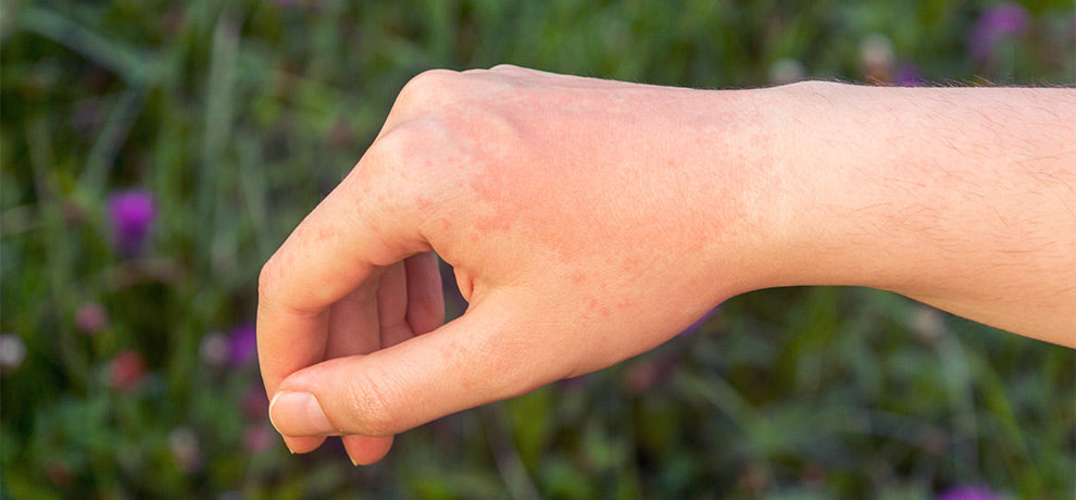 Allergie au soleil : tout savoir pour passer un bel été