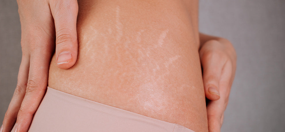 Huile essentielle pour vergetures