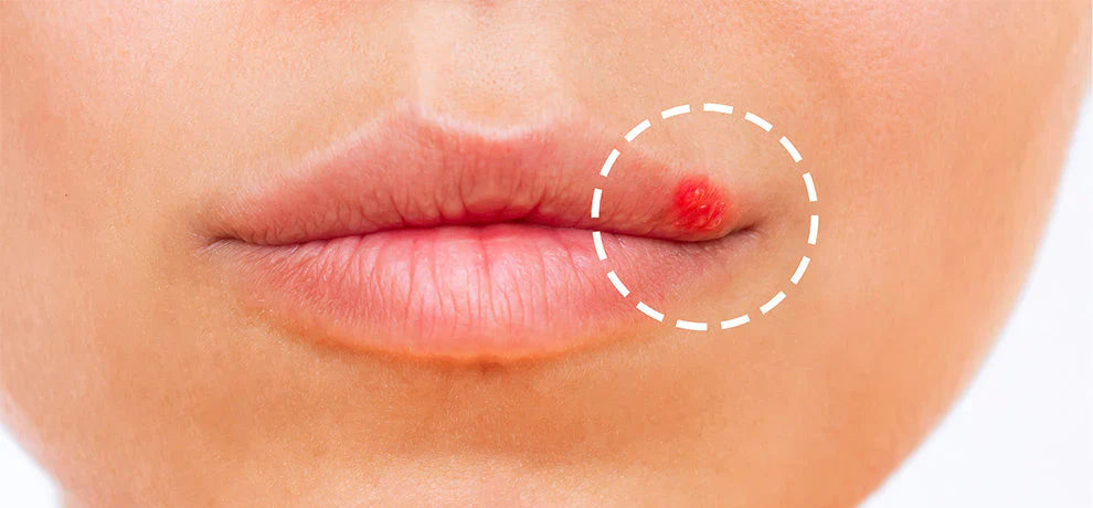 Bouton de fièvre : comment le soigner naturellement ?