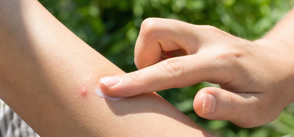 Allergie à la piqûre de moustique tigre : la reconnaître et la soulager